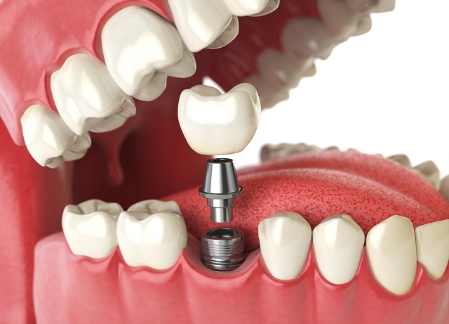 How Dental Implants Help InEasy Eating And Chewing?