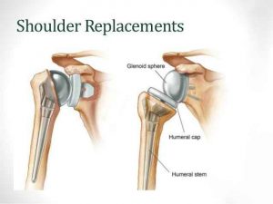 Orthopedic Surgeon Shoulder Specialist in Trichy