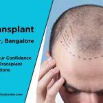 Hair Transplant in JP Nagar
