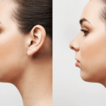 Injectable Nose Job