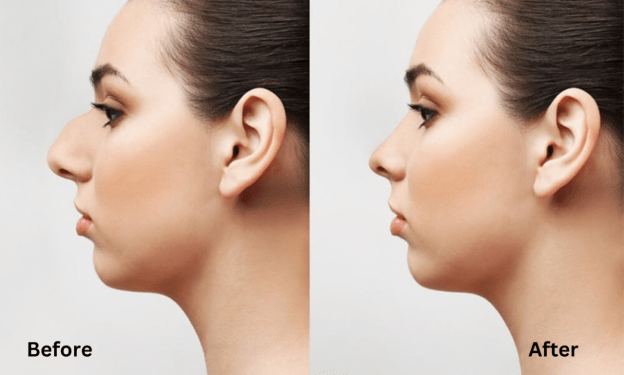 Injectable Nose Job