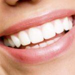 professional teeth whitening