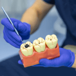 dental cavities