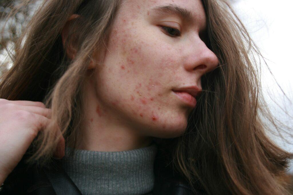 reduce acne