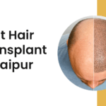 hair transplant cost in jaipur