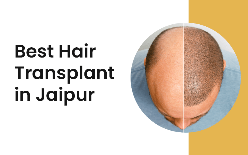 hair transplant cost in jaipur
